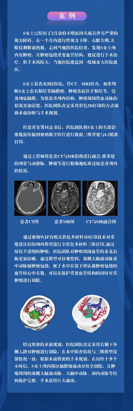 3D打印神经外科手术规划模型